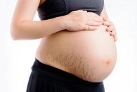 Artikel mengenai beberapa tips mencegah stretch mark untuk ibu hamil yang harus dilakukan untuk menjaga penampilan.