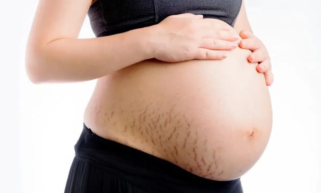 Artikel mengenai beberapa tips mencegah stretch mark untuk ibu hamil yang harus dilakukan untuk menjaga penampilan.