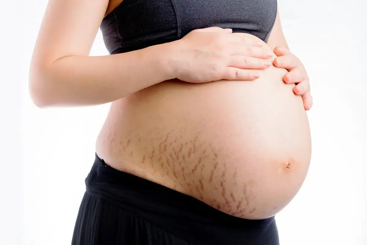 Artikel mengenai beberapa tips mencegah stretch mark untuk ibu hamil yang harus dilakukan untuk menjaga penampilan.