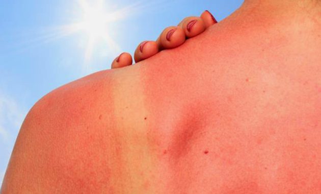 Artikel kali ini akan menawarkan beberapa cara mengatasi kulit sunburn dengan cepat dan sederhana yang bisa Anda lakukan.