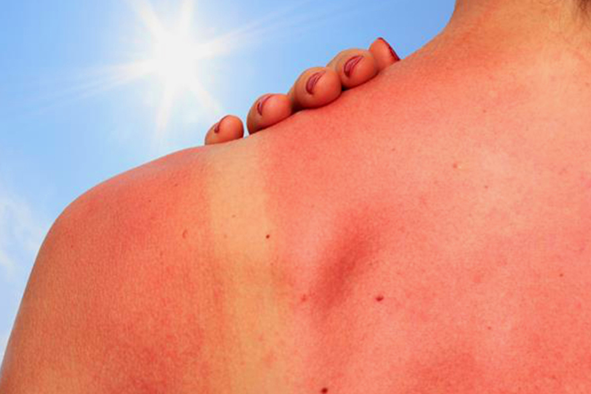 Artikel kali ini akan menawarkan beberapa cara mengatasi kulit sunburn dengan cepat dan sederhana yang bisa Anda lakukan.