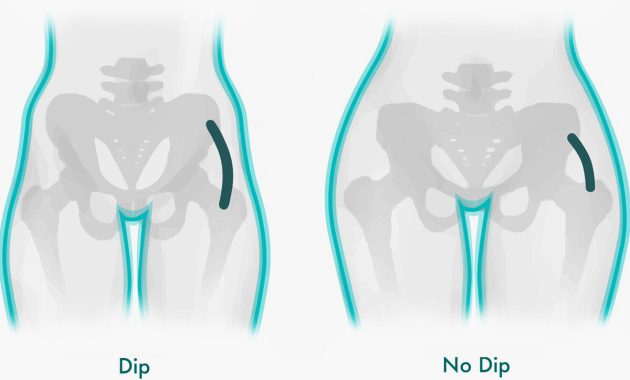 Artikel kali ini membahas mengenai apa itu hip dips atau lekukan pinggul dan mengapa tidak perlu diperbaiki karena itu normal.