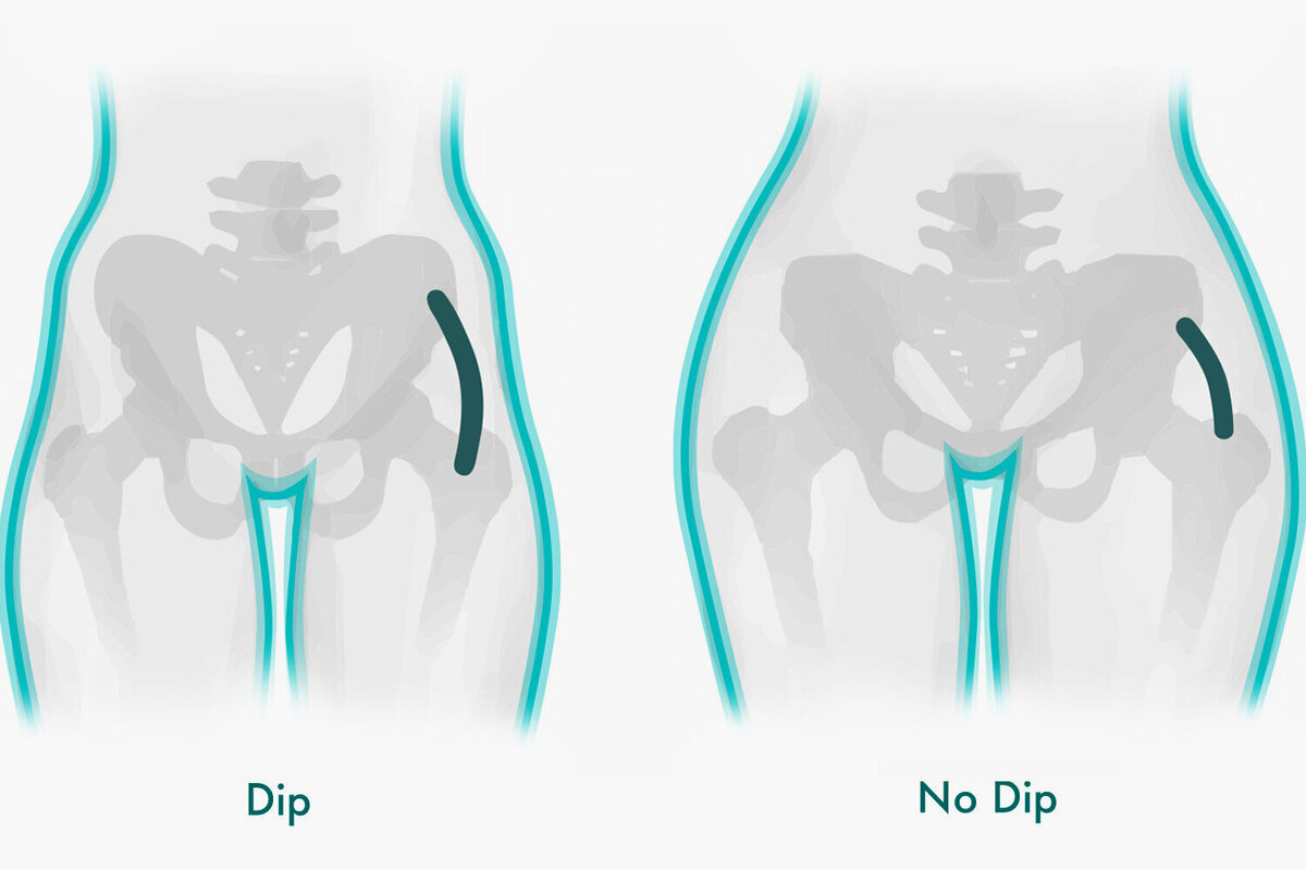 Artikel kali ini membahas mengenai apa itu hip dips atau lekukan pinggul dan mengapa tidak perlu diperbaiki karena itu normal.