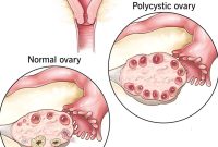 Artikel kali ini Anda akan diajak untuk memahami tentang PCOS alias Polycystic Ovarian Syndrome atau Sindrom Polikistik Ovarium.