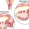 Artikel kali ini Anda akan diajak untuk memahami tentang PCOS alias Polycystic Ovarian Syndrome atau Sindrom Polikistik Ovarium.