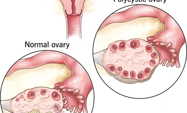 Artikel kali ini Anda akan diajak untuk memahami tentang PCOS alias Polycystic Ovarian Syndrome atau Sindrom Polikistik Ovarium.