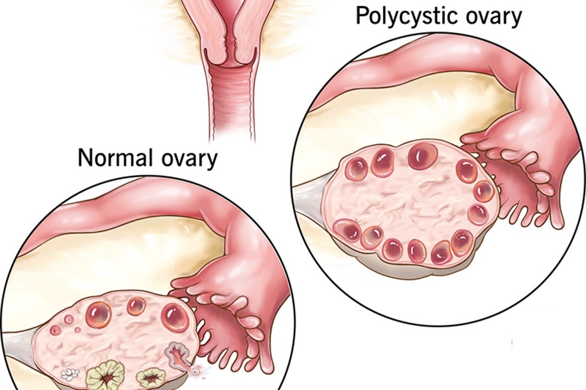 Artikel kali ini Anda akan diajak untuk memahami tentang PCOS alias Polycystic Ovarian Syndrome atau Sindrom Polikistik Ovarium.