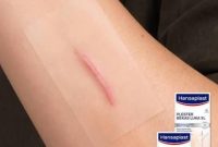 Artikel kali ini membahas mengenai beberapa cara menghilangkan bekas luka keloid yang efektif dengan hansaplast.