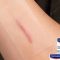 Artikel kali ini membahas mengenai beberapa cara menghilangkan bekas luka keloid yang efektif dengan hansaplast.