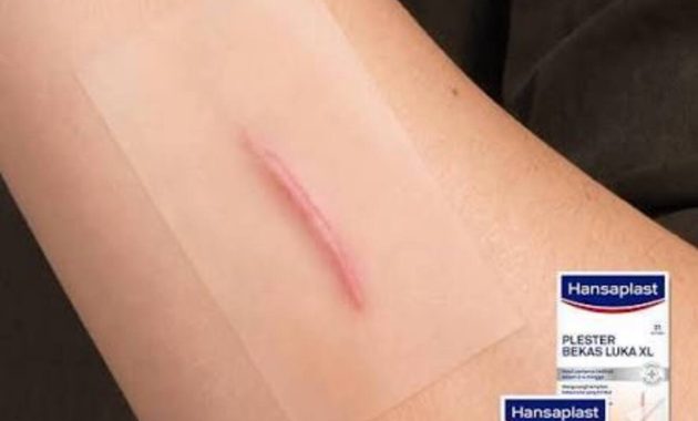 Artikel kali ini membahas mengenai beberapa cara menghilangkan bekas luka keloid yang efektif dengan hansaplast.