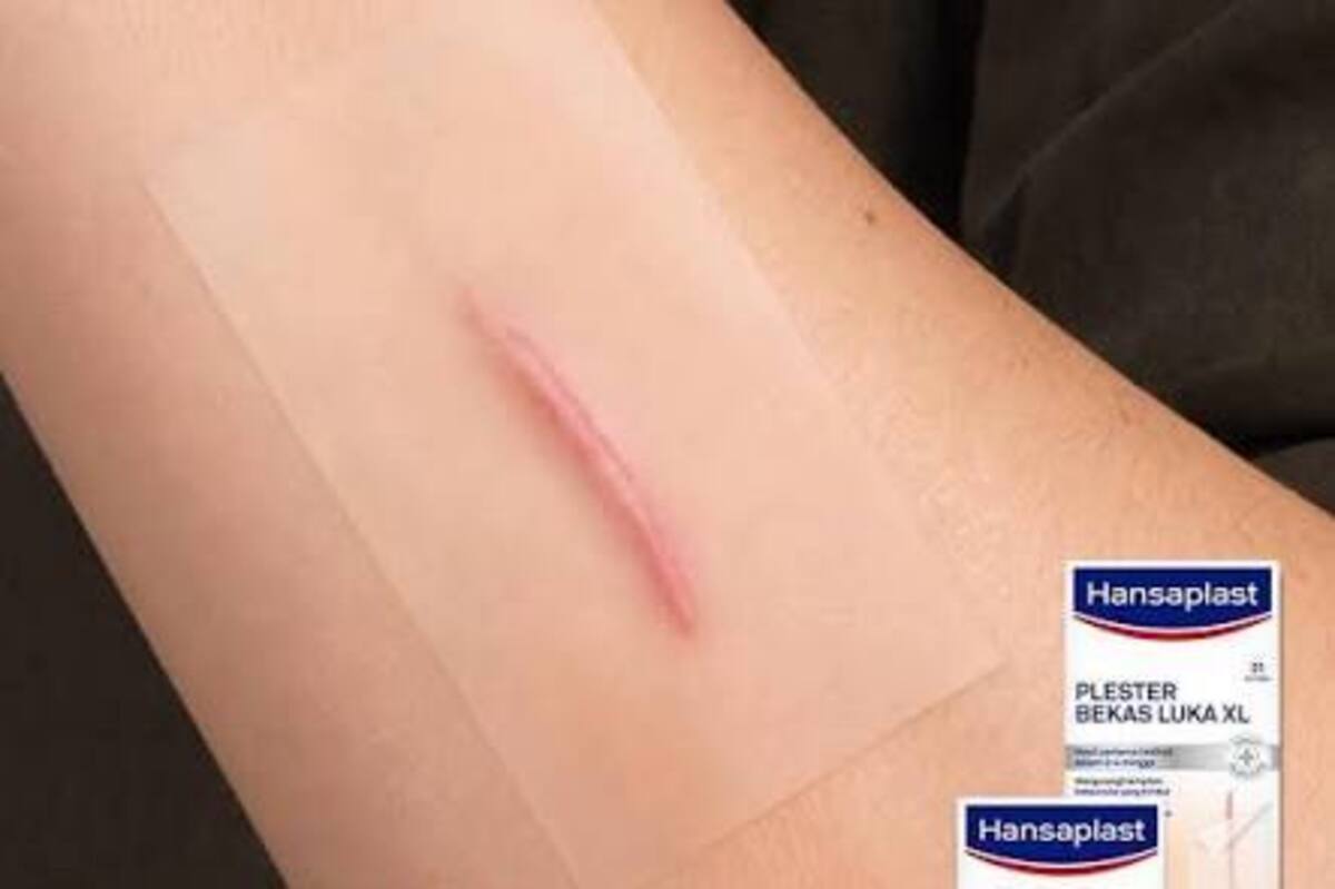 Artikel kali ini membahas mengenai beberapa cara menghilangkan bekas luka keloid yang efektif dengan hansaplast.