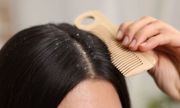 Artikel kali ini membahas mengenai beberapa penyebab rambut berketombe yang harus dihindari agar rambut bersih tanpa ketombe.