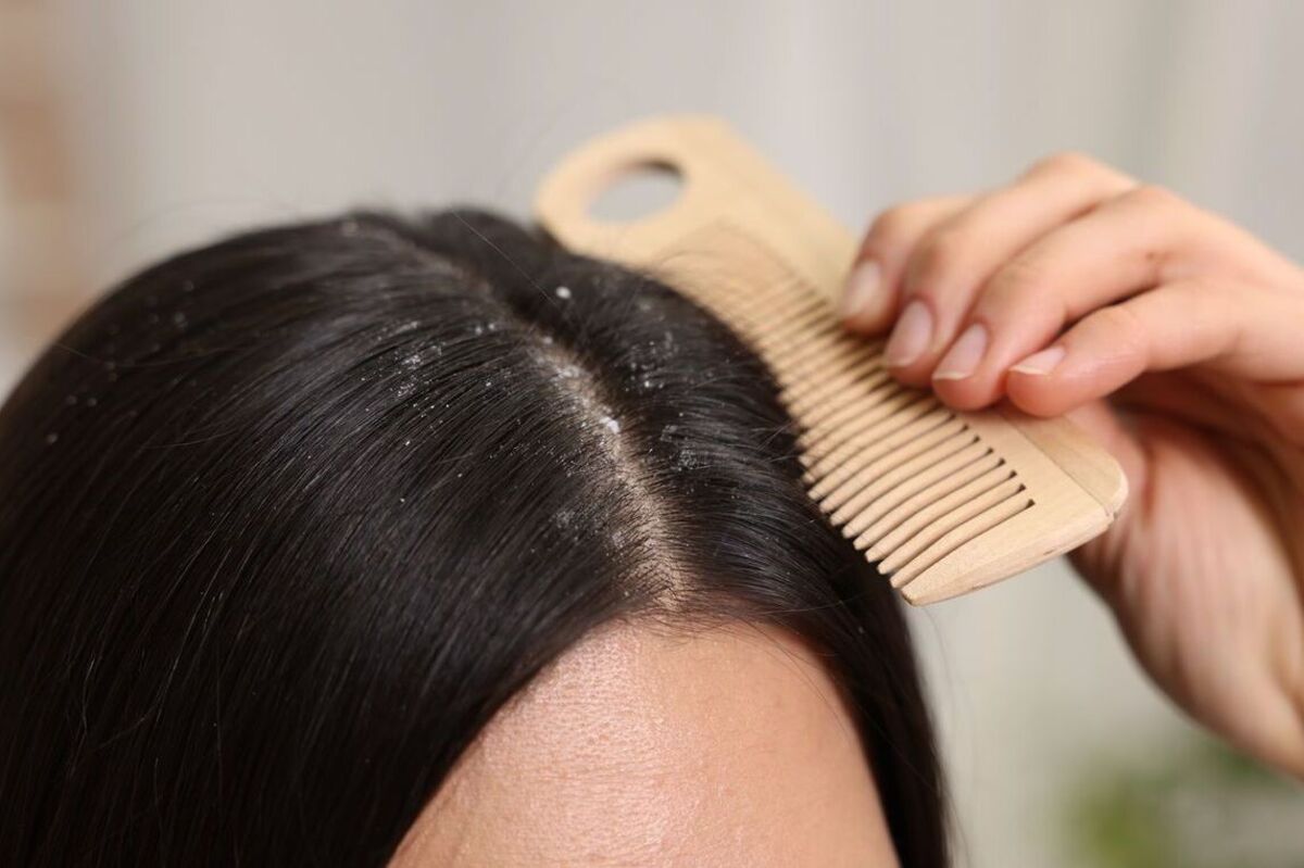 Artikel kali ini membahas mengenai beberapa penyebab rambut berketombe yang harus dihindari agar rambut bersih tanpa ketombe.