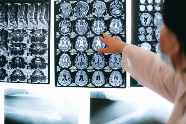Radiolog menunjuk pada pemindaian MRI otak / pexels-shvetsa